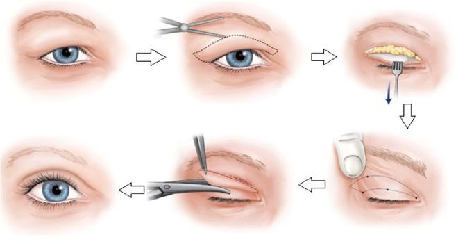 Mắt một mí phẫu thuật thành hai mí tốn bao nhiêu tiền? (2)